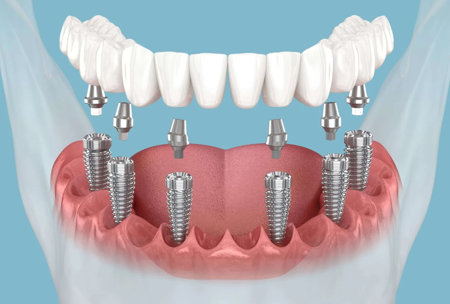 Dental Implants Middlesbrough