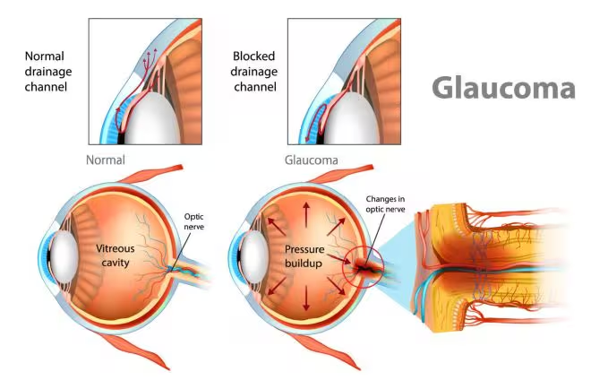 How Glaucoma May Affect Vision Over Time
