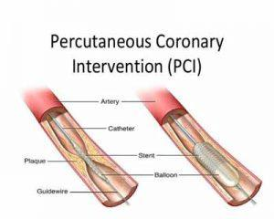 What Is Emergency PCI and When Is It Used for a Heart Attack?
